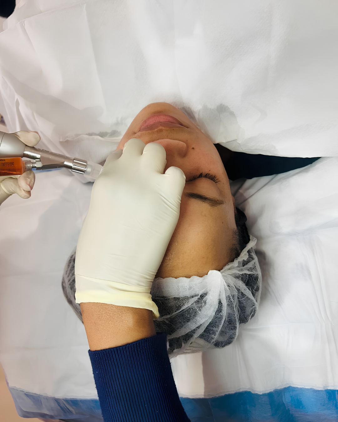 HydraFacial Treatment