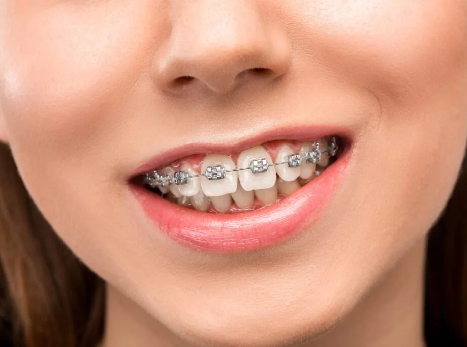 Teeth Straightening