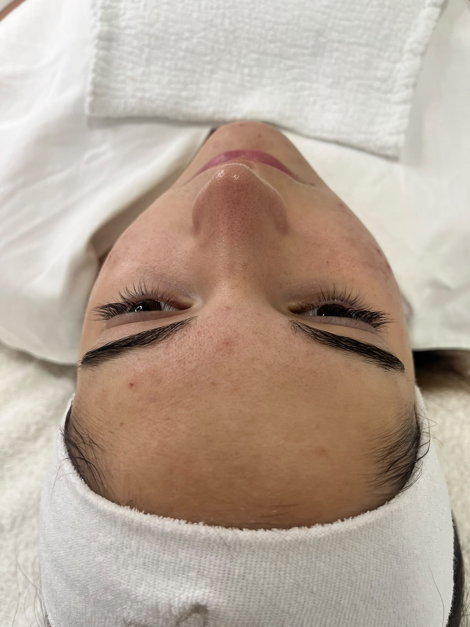 Kozmetikai kezelés eredménye Zalaegerszeg - White Rose Beauty referencia 2