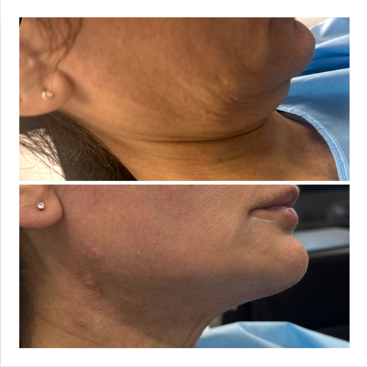 XERF before and after example 4