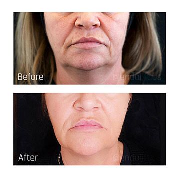 XERF before and after example 1