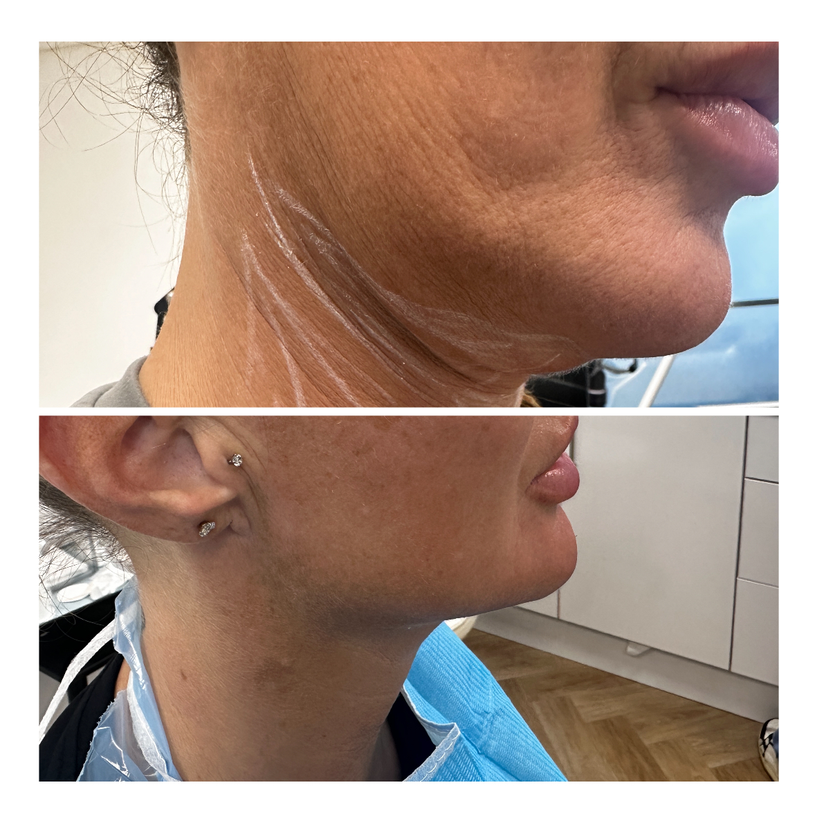 XERF before and after example 5
