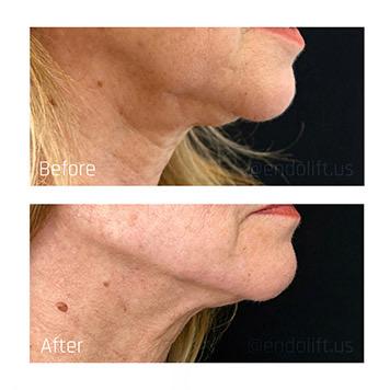 XERF before and after example 2