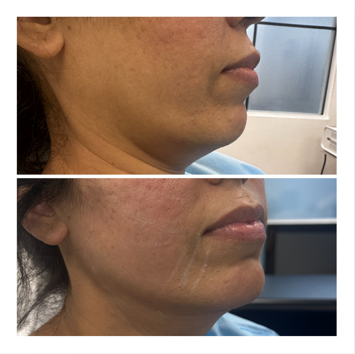 XERF before and after example 3