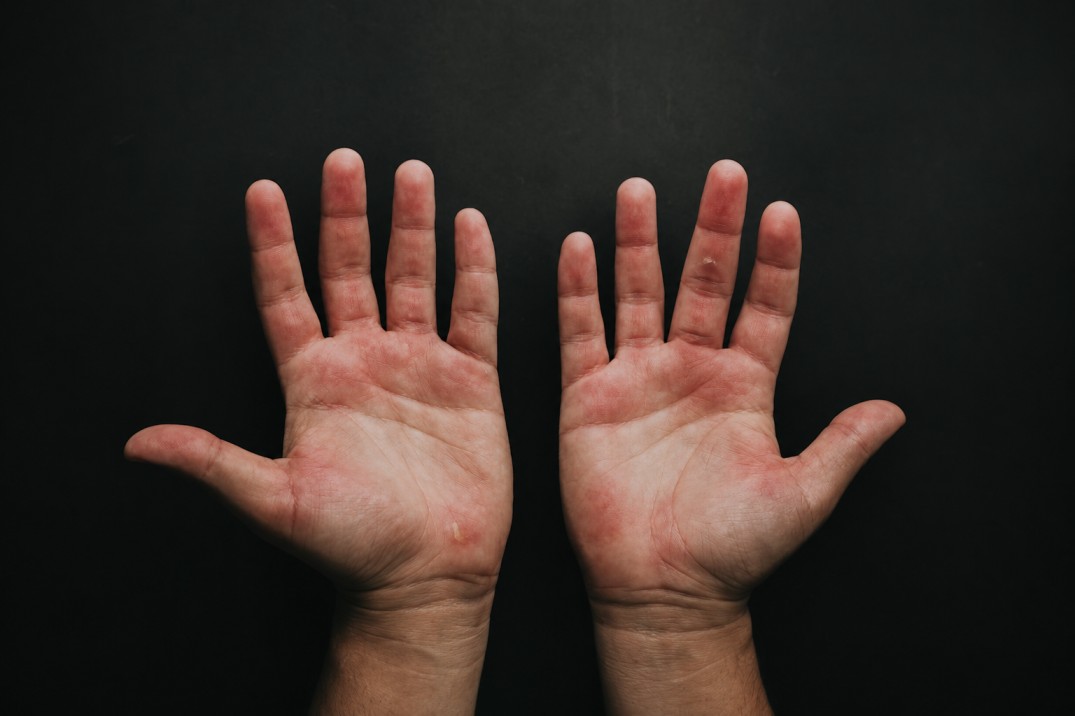 Raw Hands
