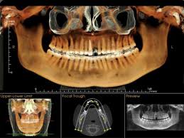 Cone Beam CBCT 3D Scan