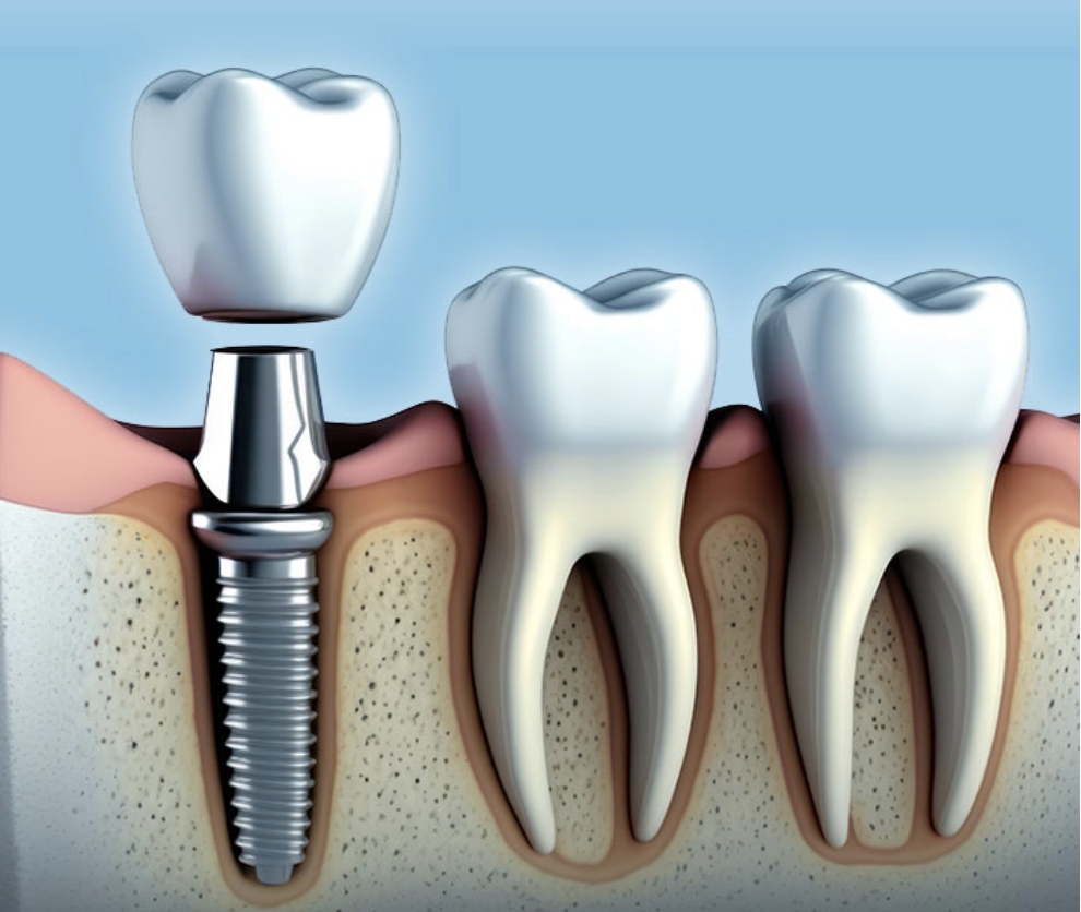 Dental Implants Illustration