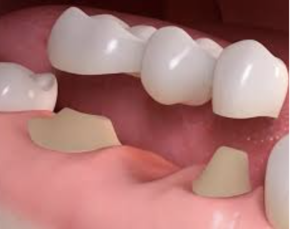 Custom Dental Bridges Illustration