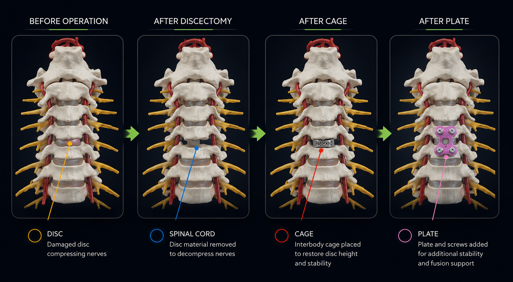 Anterior Cervical Discectomy and Fusion (ACDF) Procedure Steps