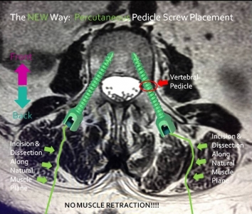 The New Way: Percutaneous Pedicle Screw Placement