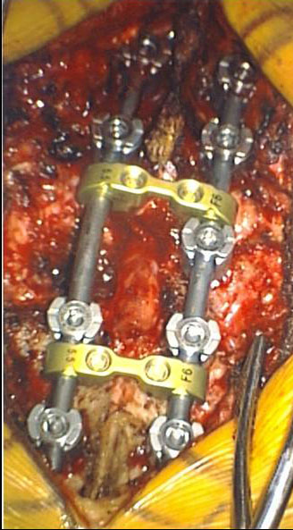 Open Surgery