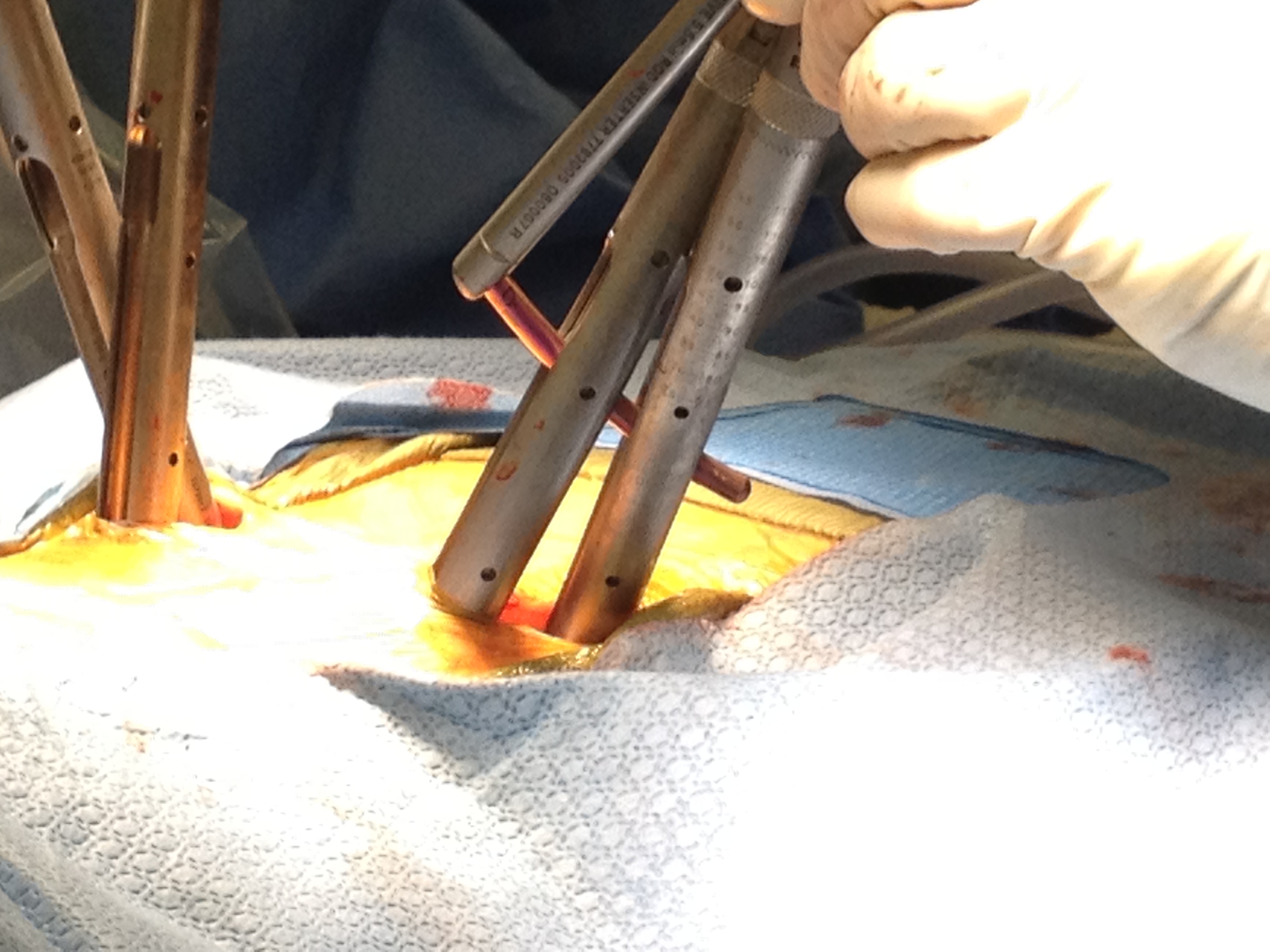 Minimally Invasive Tubes