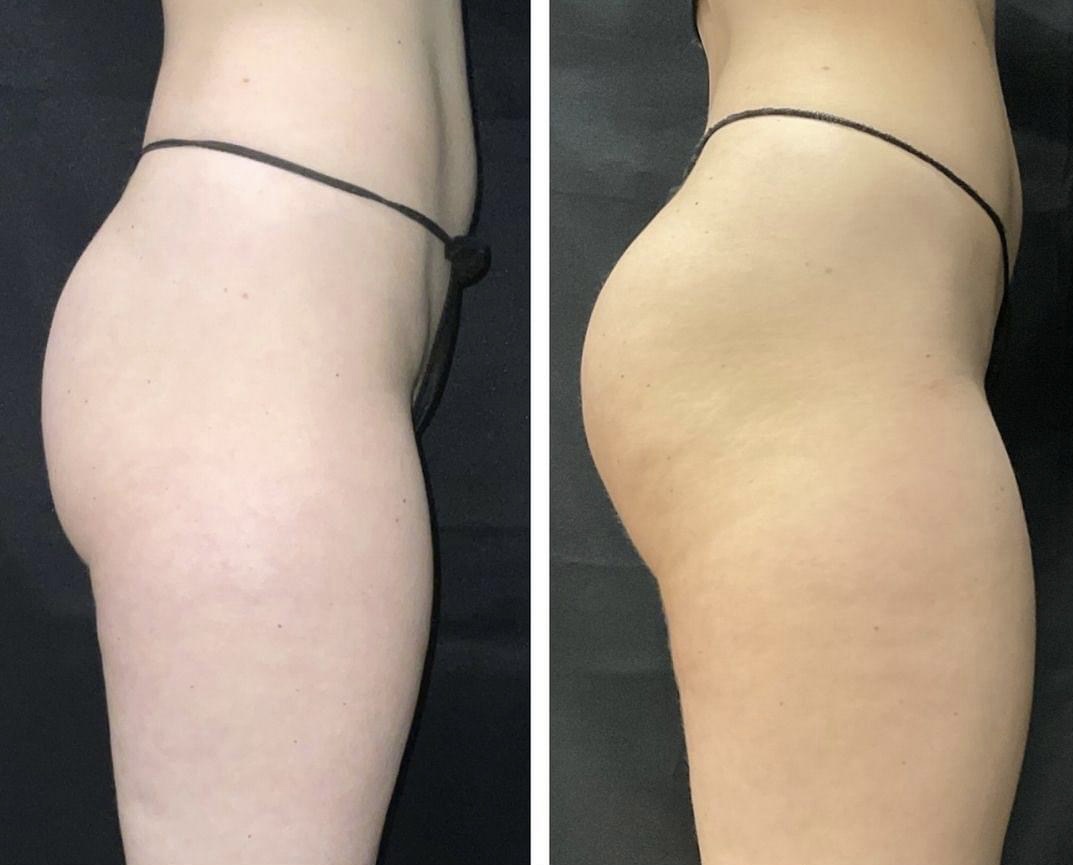 Buttocks Before and After