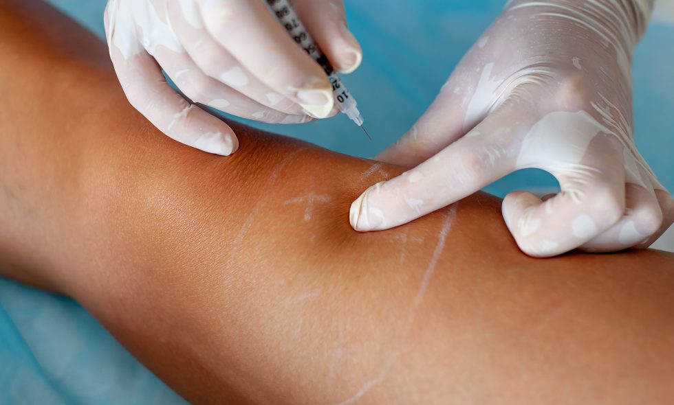 Escleroterapia