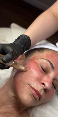 Microneedling skin renewal treatment