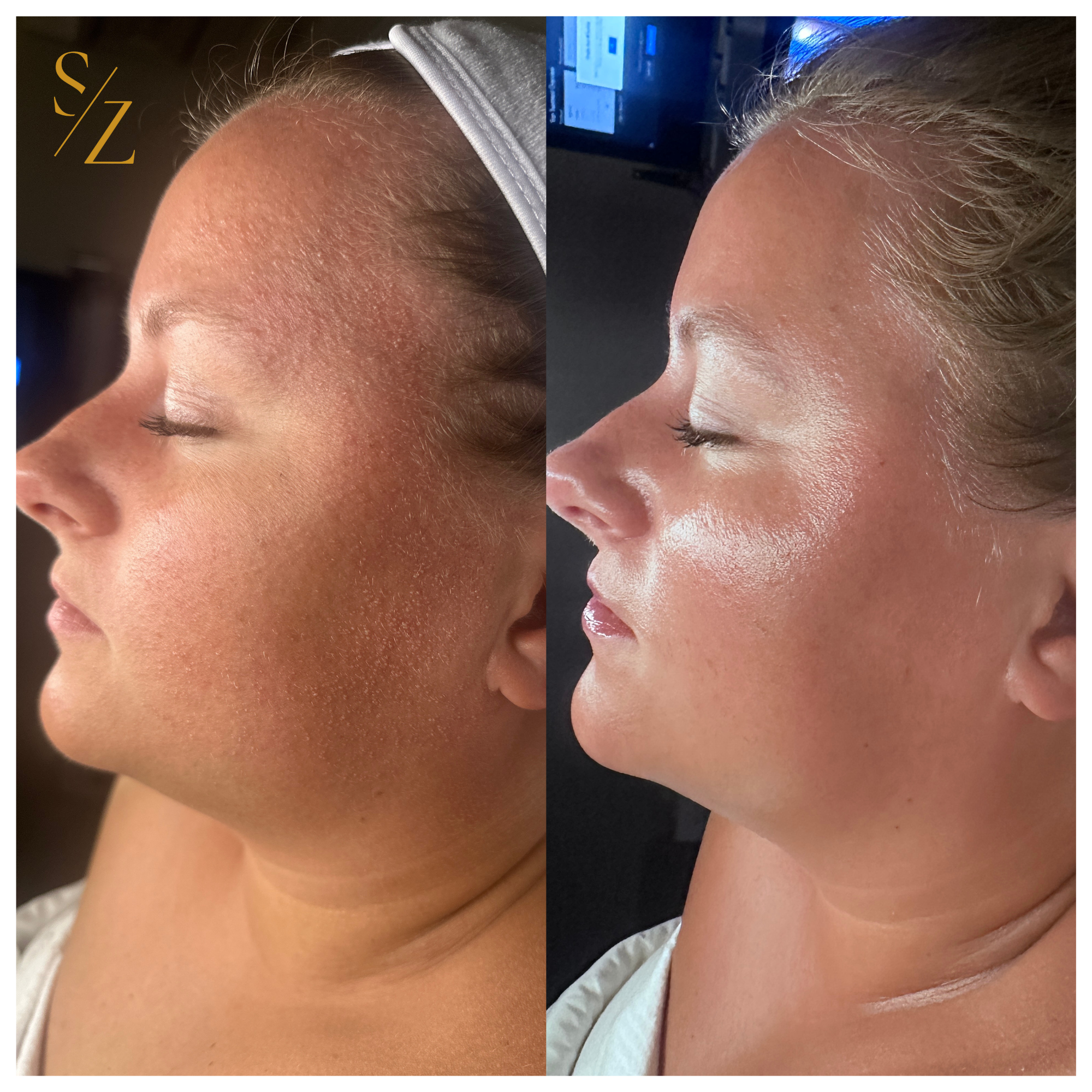Before and after acne treatment showing clearer skin after corrective skincare at Studio Z Aesthetics