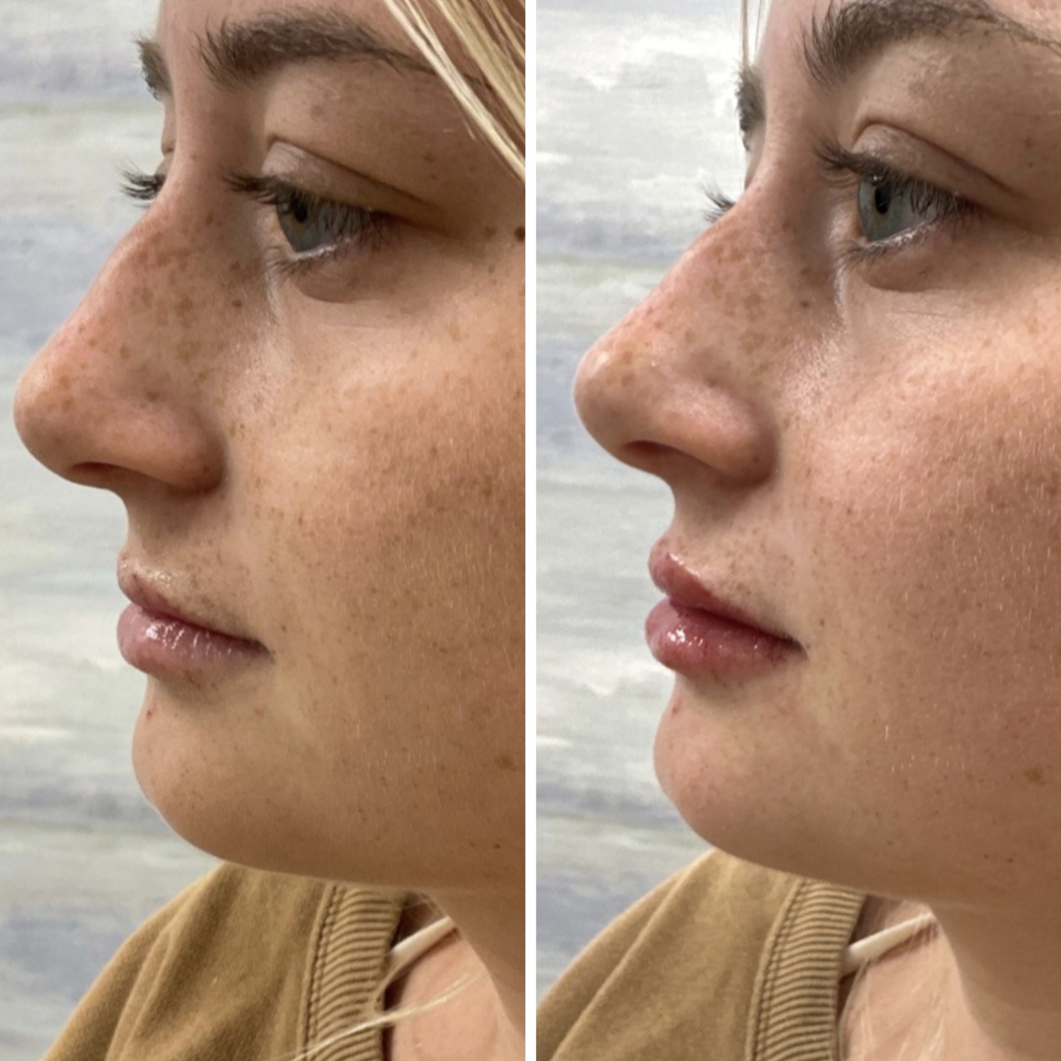 Before and after dermal filler treatment showing restored volume and balanced facial contours