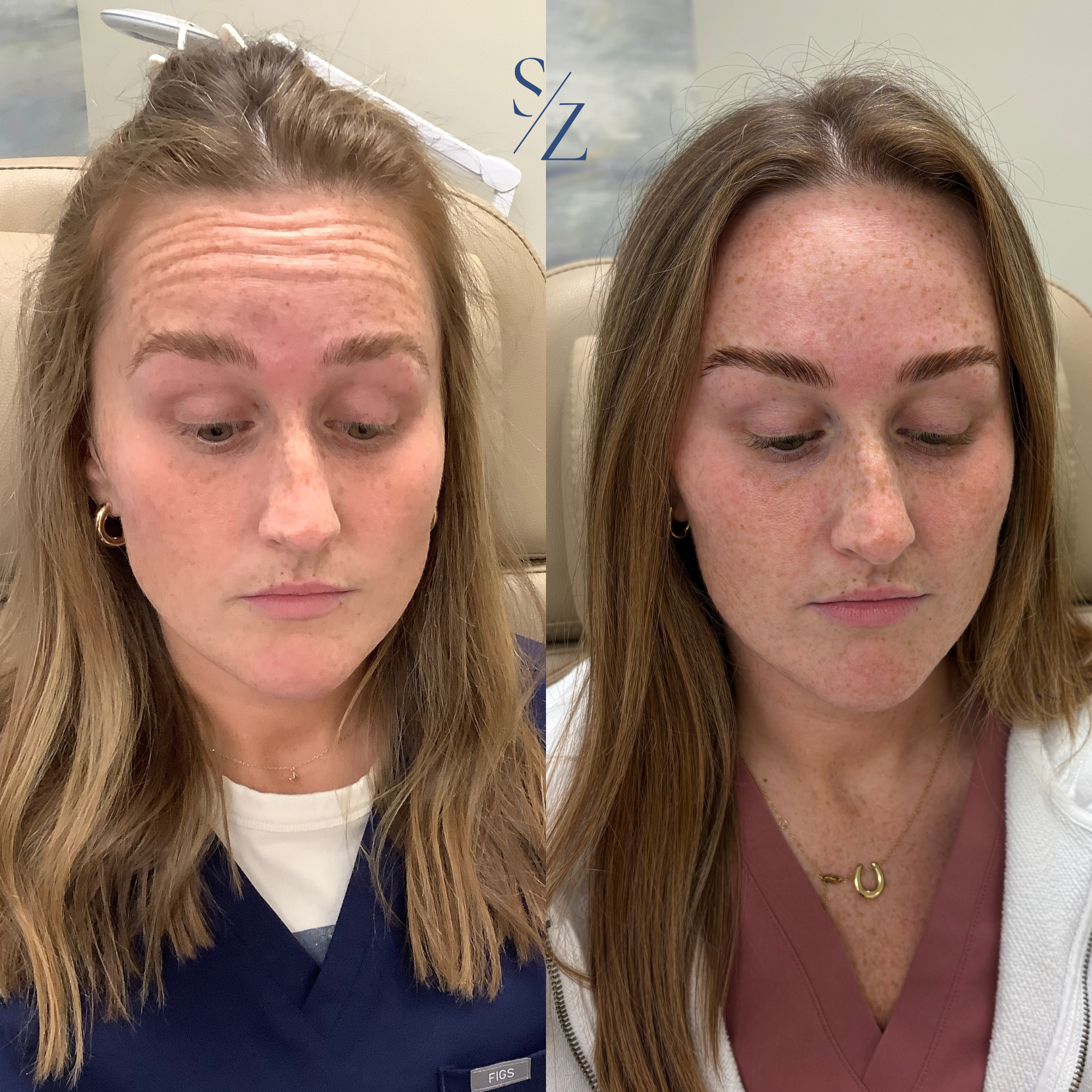 Before and after wrinkle reducer treatment showing smoother expression lines and relaxed appearance