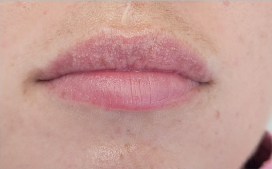 Lip design u Čakovcu - prije tretmana