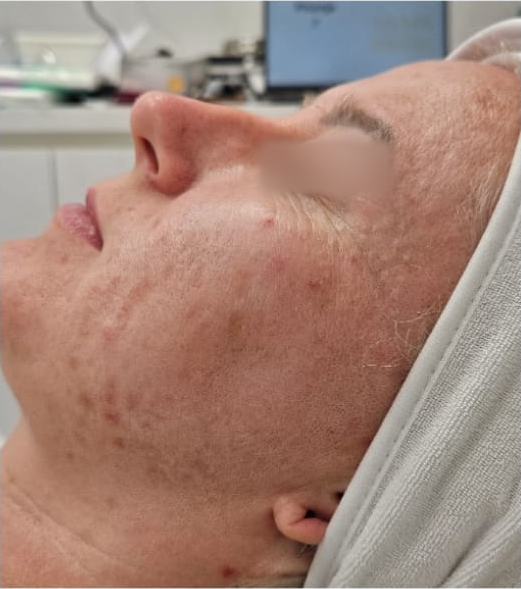 Nekirurška estetska medicina u Čakovcu - prije tretmana