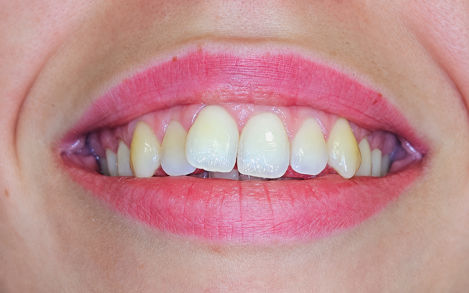 Six Month Smiles u Čakovcu - Prije terapije