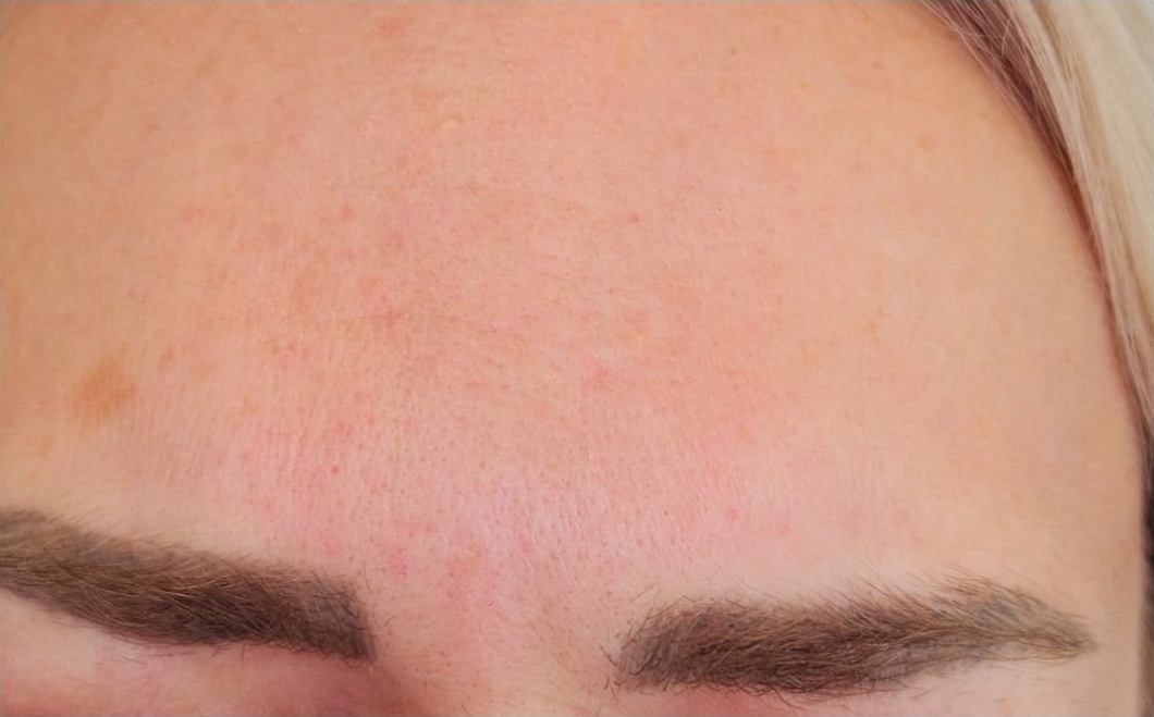 Botox tretmani u Čakovcu - poslije tretmana