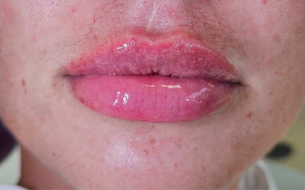 Lip design u Čakovcu - poslije tretmana