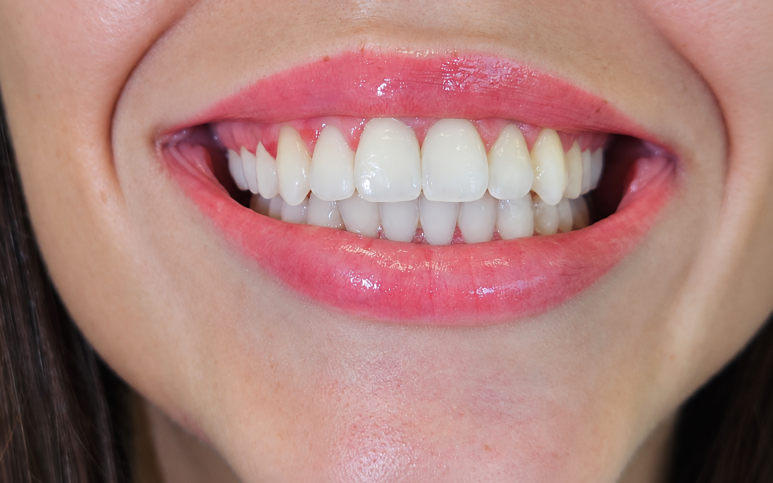 Six Month Smiles u Čakovcu - Poslije terapije