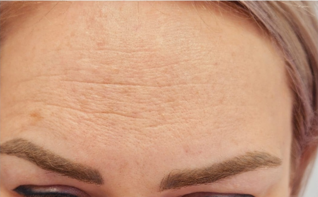 Botox tretmani u Čakovcu - prije tretmana