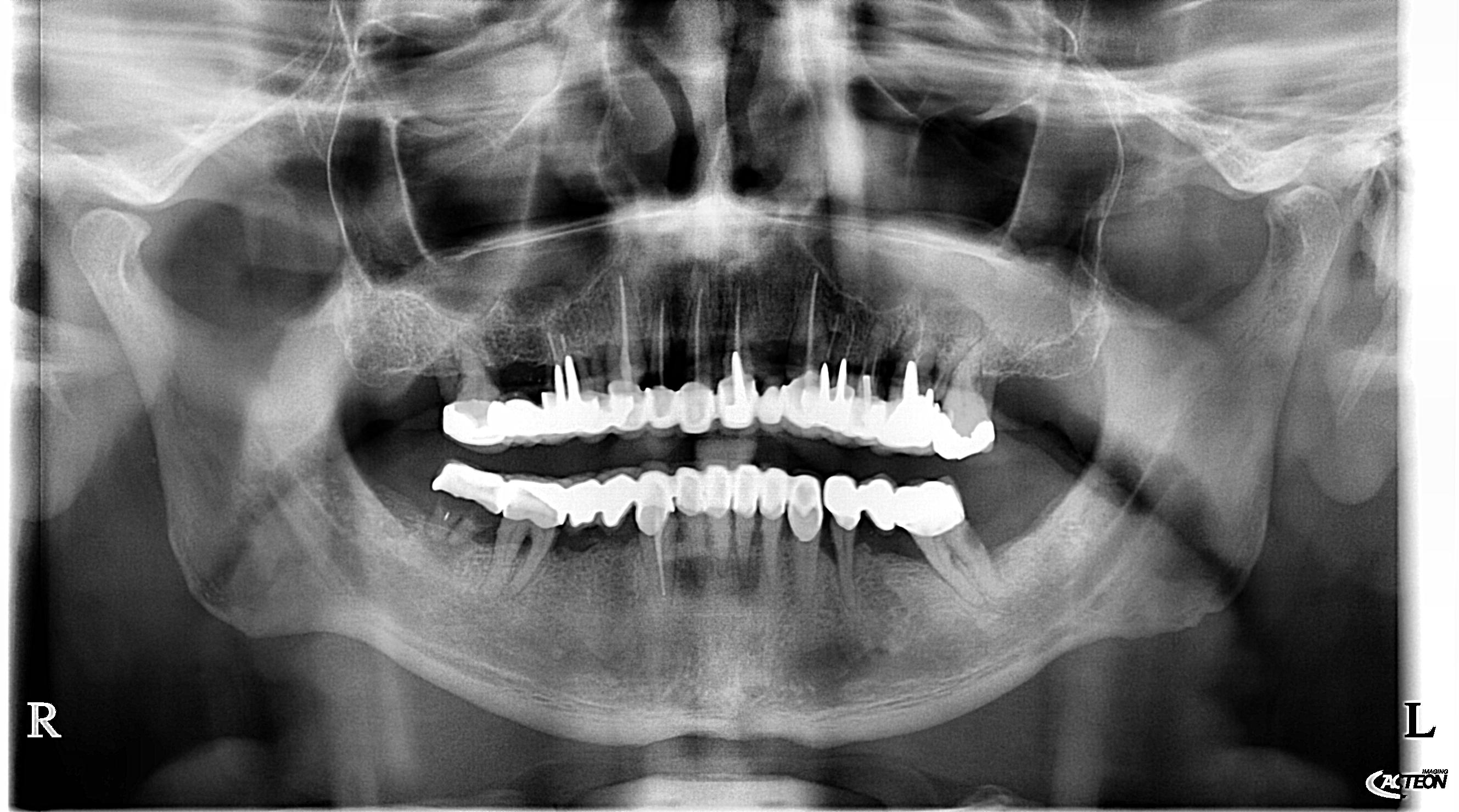 Panoramica prima della riabilitazione implantare completa