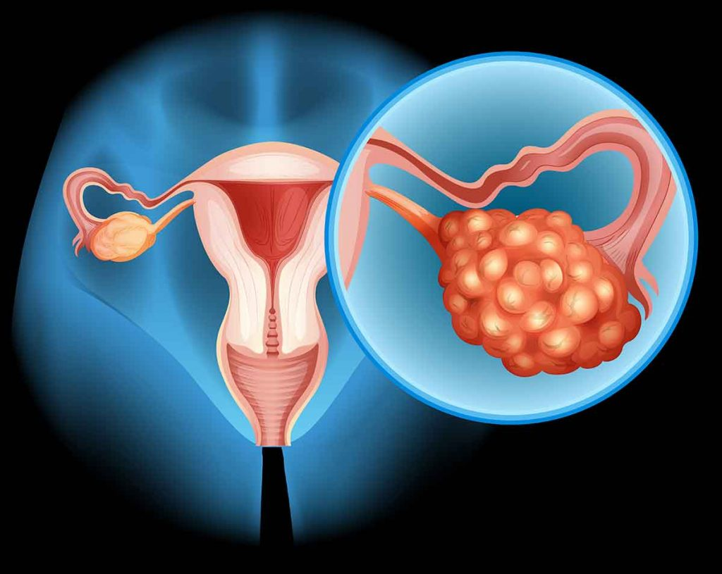 Artículo de nutrición: Síndrome de Ovario Poliquístico (SOP): Abordaje desde la nutrición