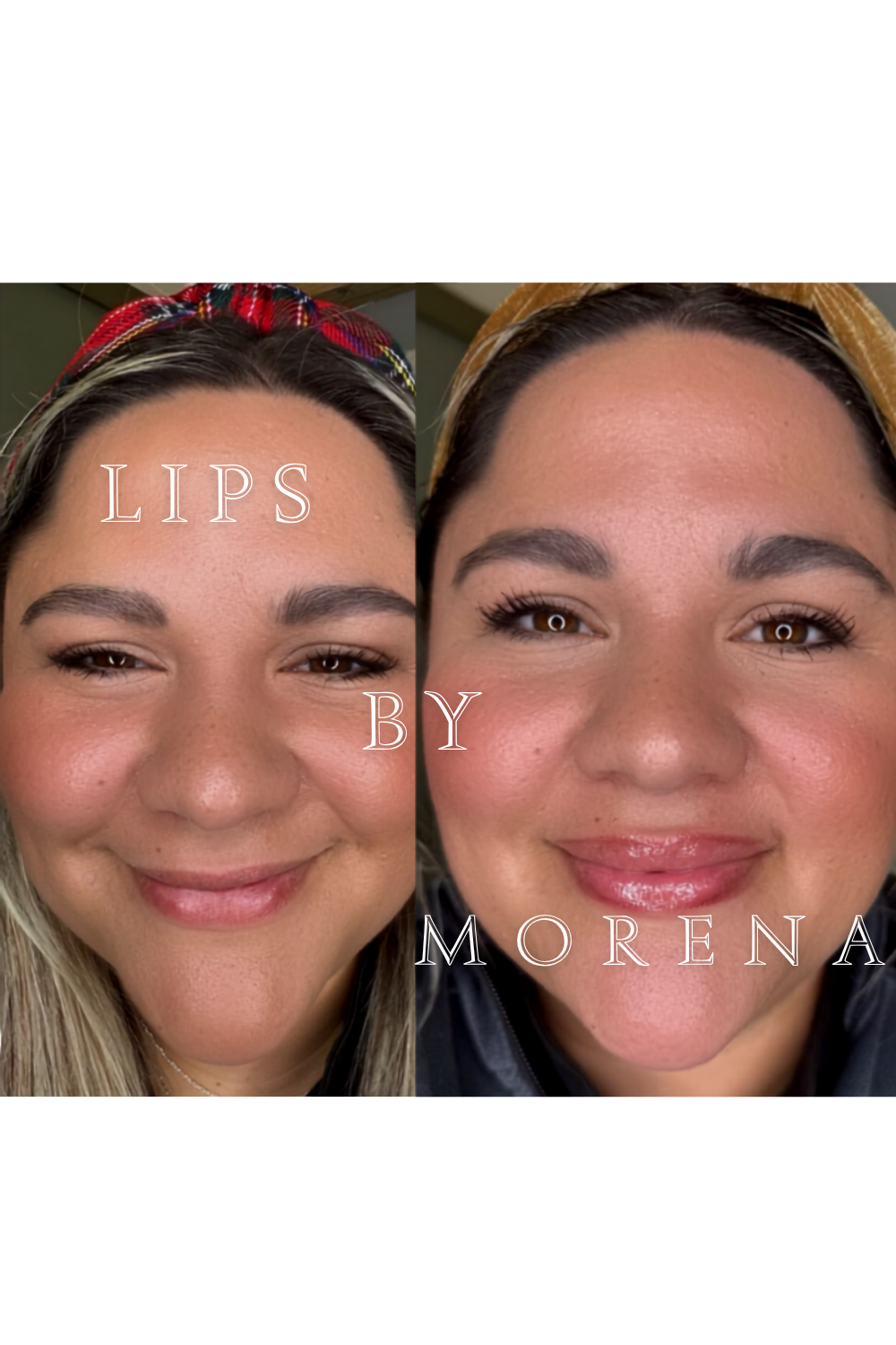 Lip filler before and after result