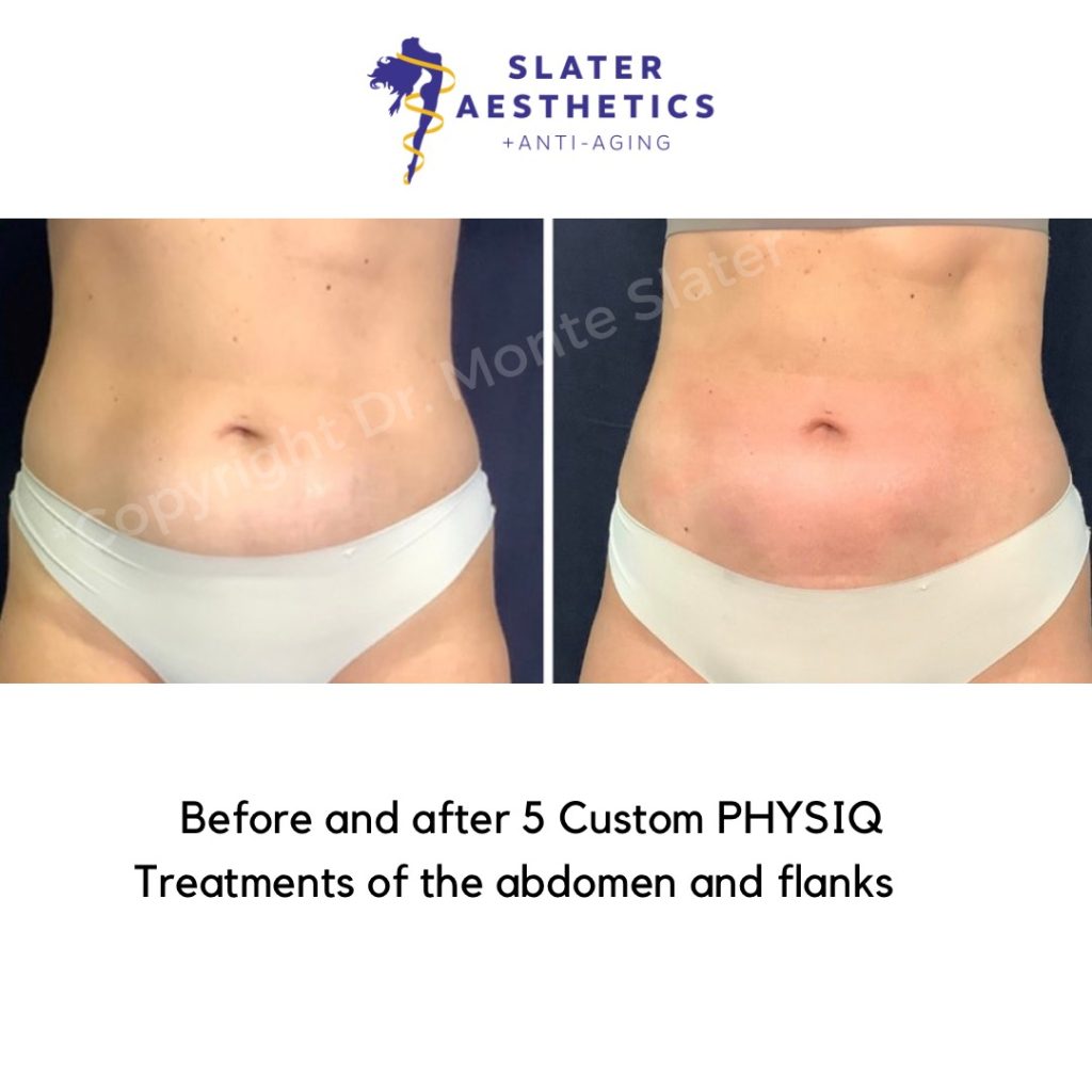 PHYSIQ Before and After 4