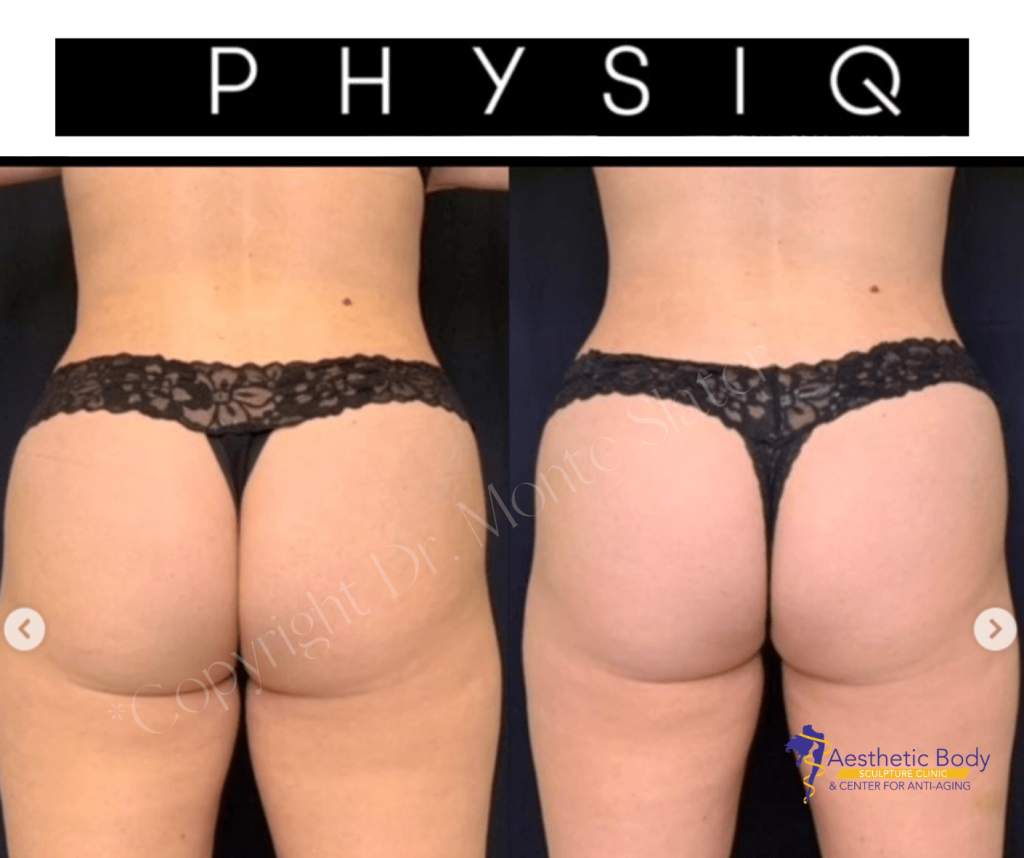 PHYSIQ Before and After 5