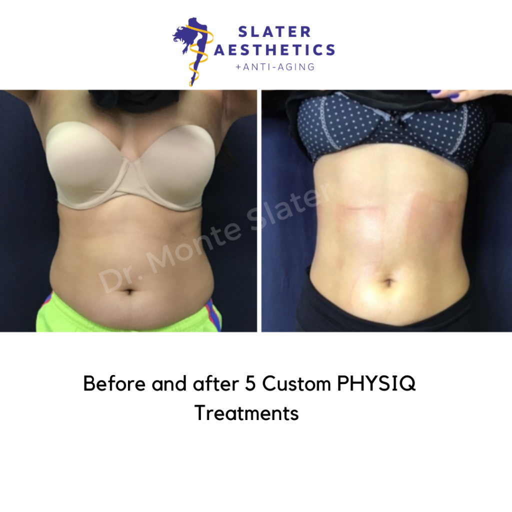PHYSIQ Before and After 2