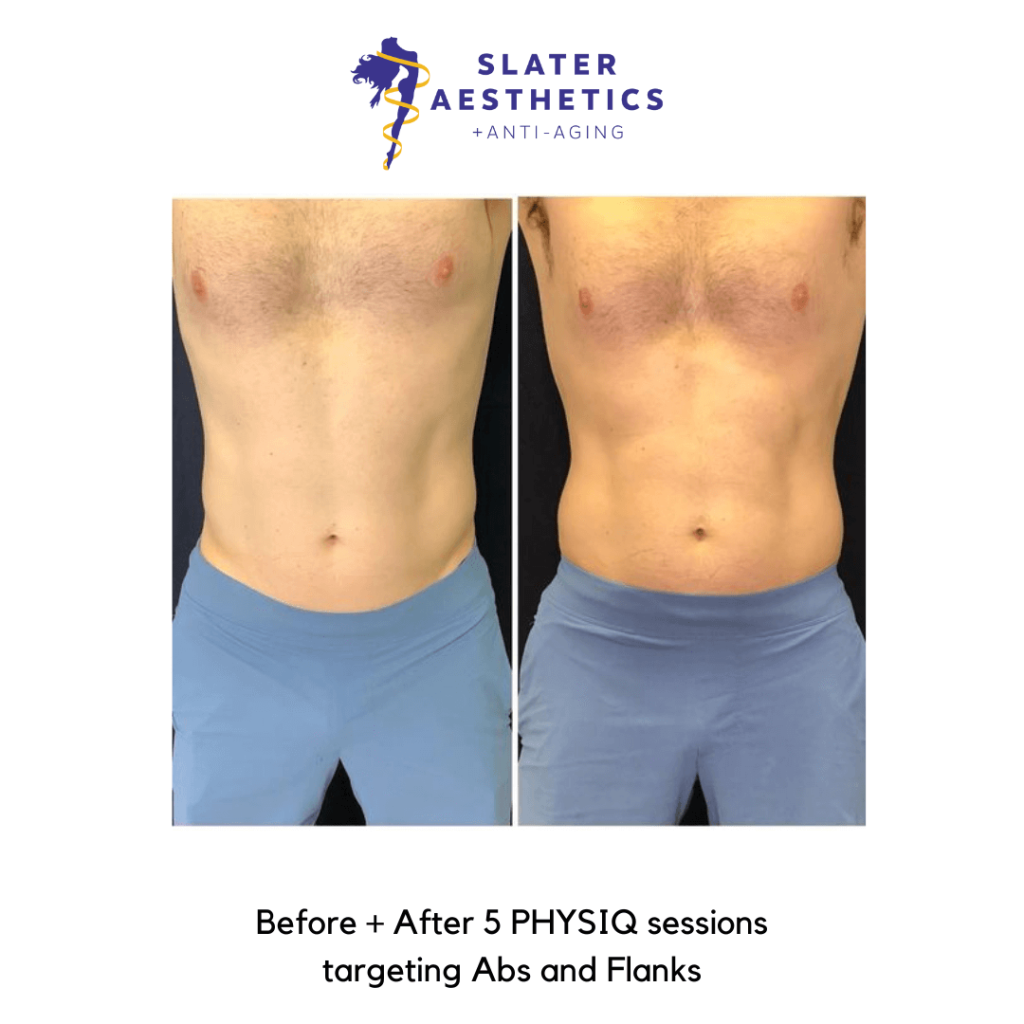 PHYSIQ Before and After 1