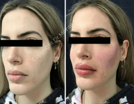 Before and after facial dermal filler and lip augmentation by Dr. Monte Slater at Slater Aesthetics in Warner Robins GA using Restylane products