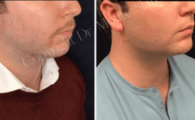 Restylane Defyne before and after results for chin and jawline enhancement at Slater Aesthetics anti-aging clinic Georgia