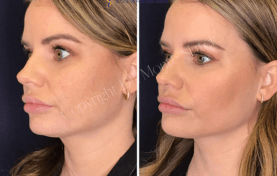 Before and immediately after Restylane Defyne for chin and jaw line enhancement by Dr. Monte Slater at Slater Aesthetics med spa Atlanta GA