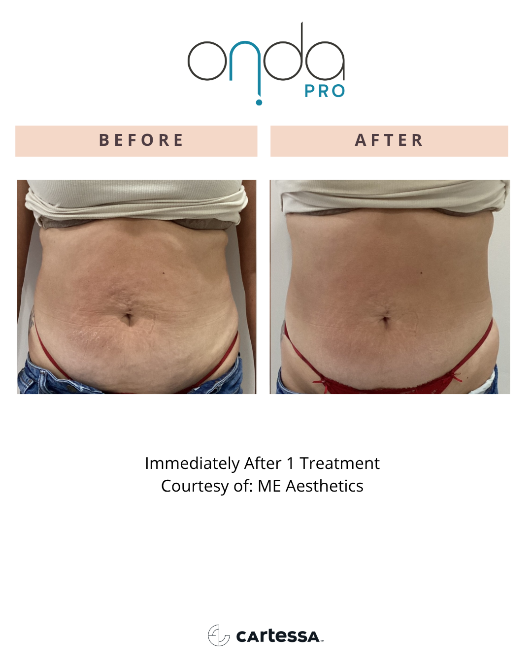ONDA PRO before and after midsection rejuvenation at Slater Aesthetics Atlanta