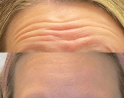 Before and 2 weeks after Dysport treatment to minimize forehead lines by Dr. Monte Slater at Slater Aesthetics med spa Atlanta GA