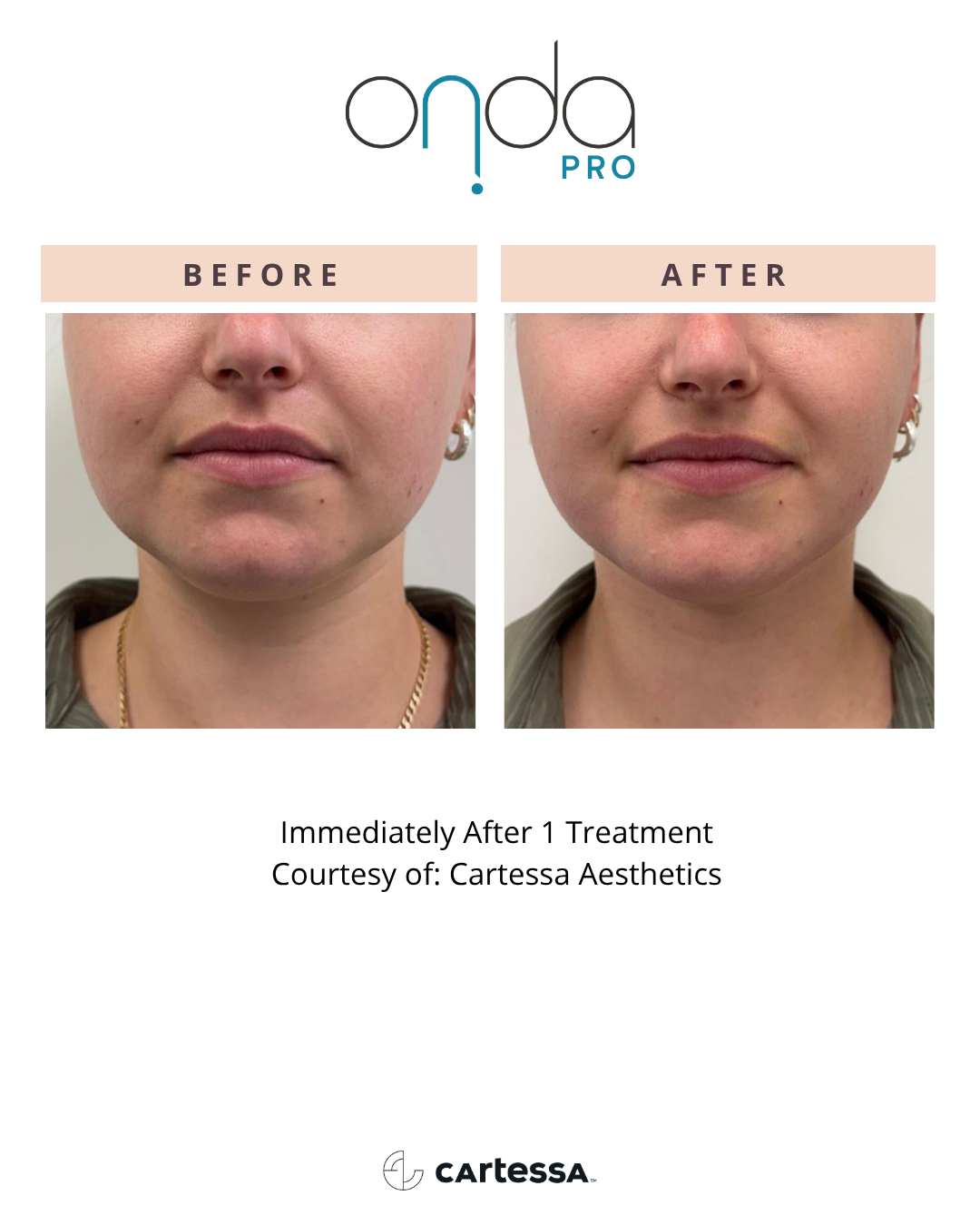ONDA PRO before and after chin and jawline contouring at Slater Aesthetics Atlanta