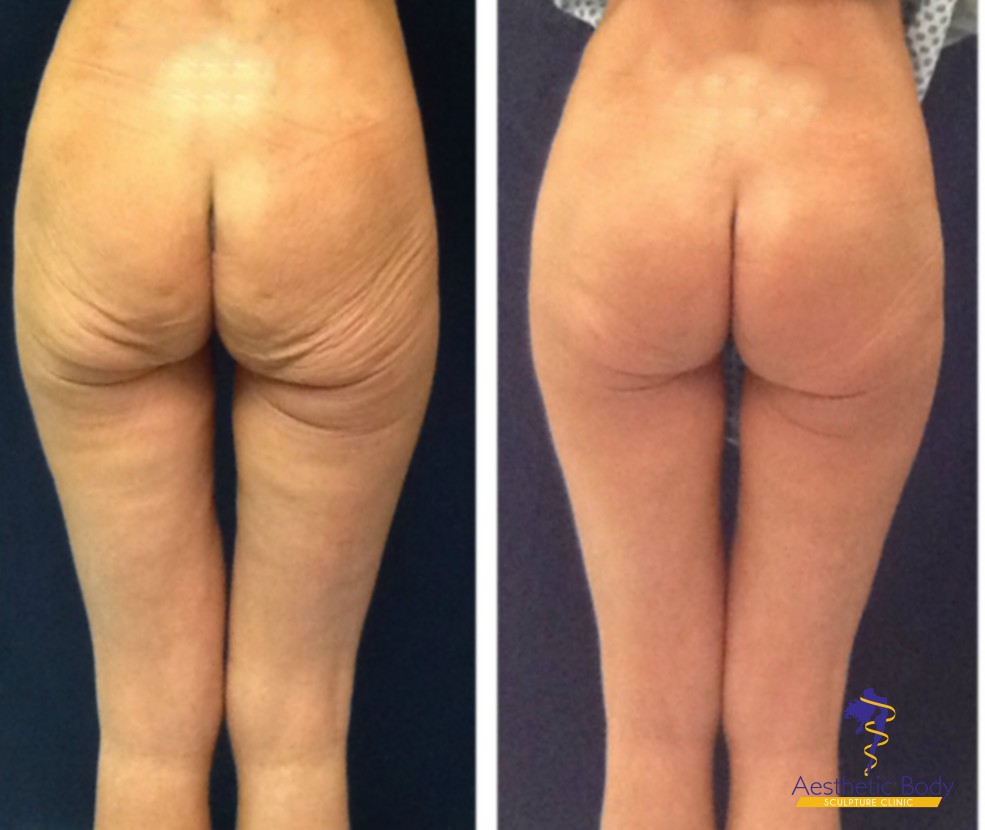 Sculptra butt lift posterior view before and after at Slater Aesthetics med spa Georgia showing improved gluteal volume and skin texture