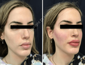 Before and immediately after Dermal Filler By Dr. Monte Slater - Juvederm Ultra Plus XC to treat hollow temples at Slater Aesthetics med spa Atlanta GA