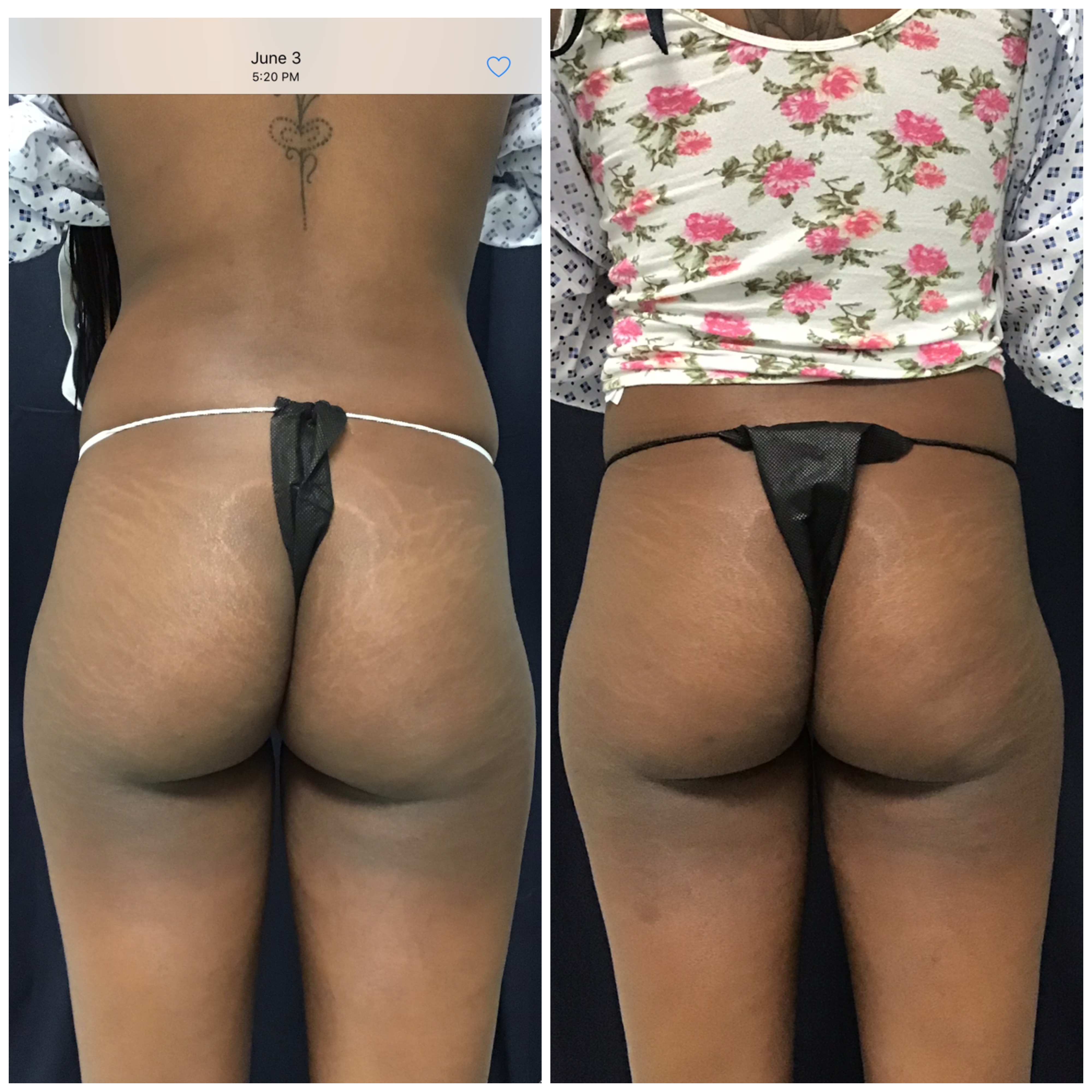 Sculptra butt lift full posterior view before and after by Dr. Monte Slater at Slater Aesthetics med spa Georgia showing complete gluteal transformation