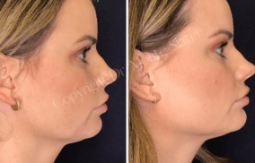 Before and immediately after Restylane Defyne for chin and jaw line enhancement by Dr. Monte Slater at Slater Aesthetics med spa Atlanta GA