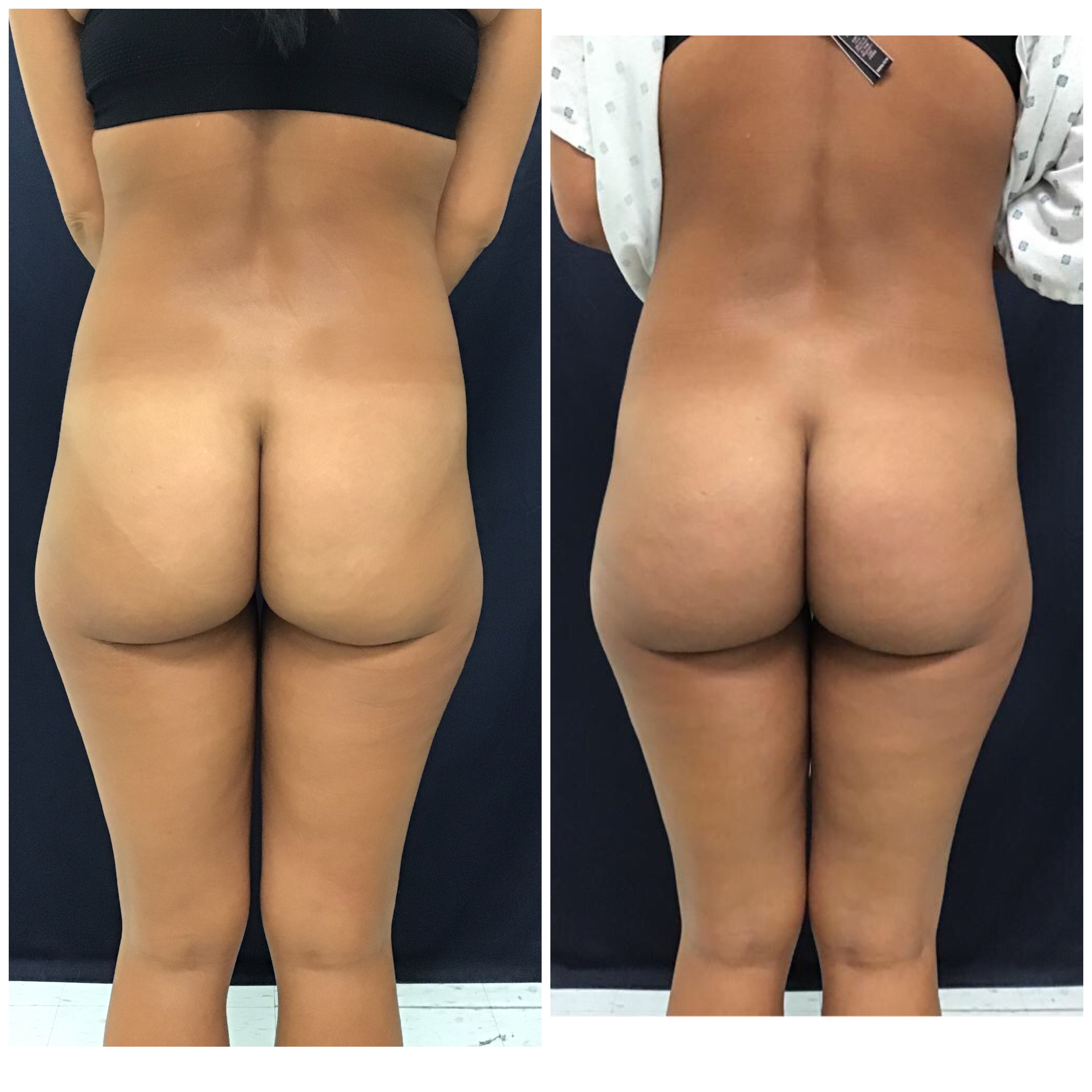 Before and after Sculptra body sculpting full posterior view by Dr. Monte Slater at Slater Aesthetics med spa Georgia showing thigh and buttock transformation