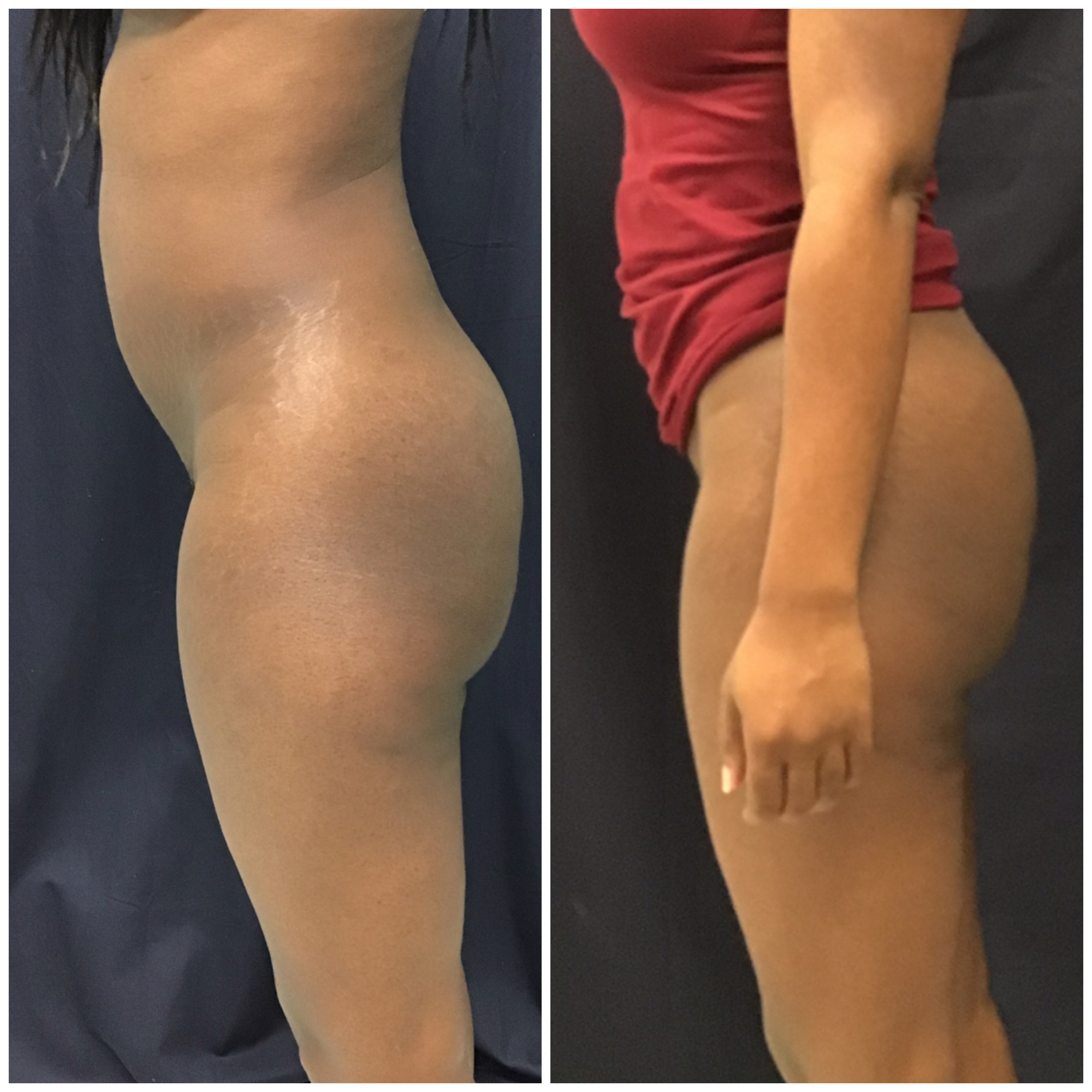 Before and after Sculptra full body side profile at Slater Aesthetics med spa in Atlanta GA showing complete lower body transformation
