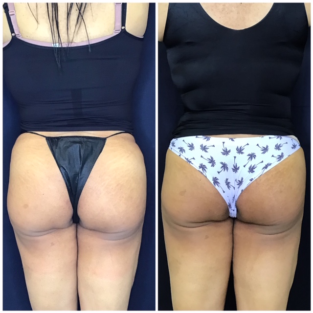 Before and after Sculptra butt lift back view results by Dr. Monte Slater at Slater Aesthetics Warner Robins GA showing improved gluteal volume and shape