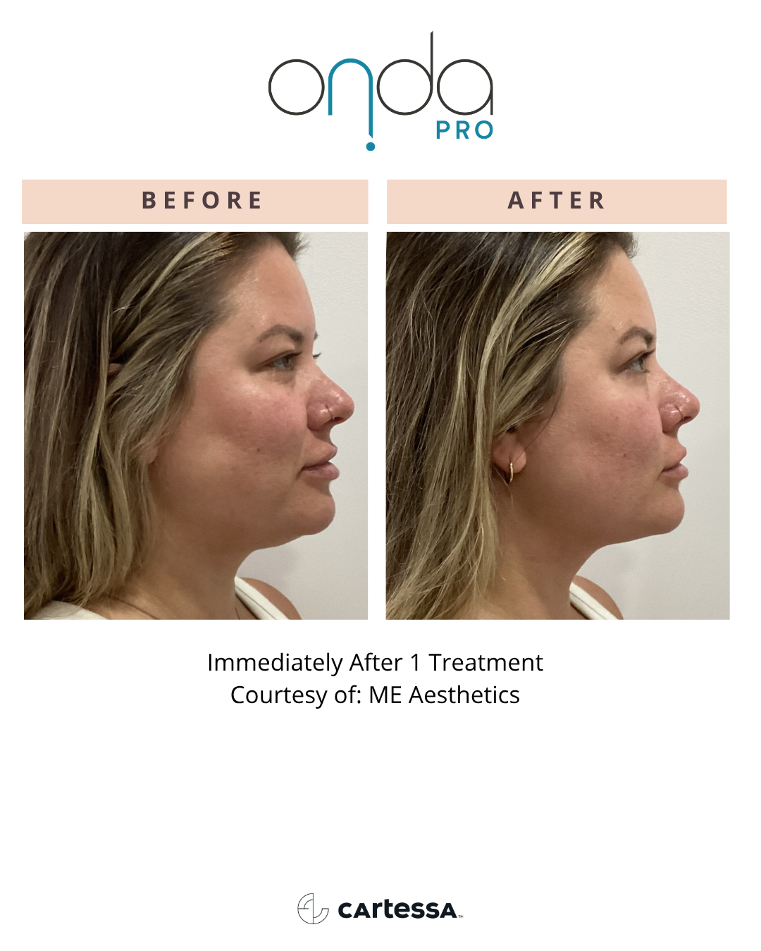 ONDA PRO before and after side profile contouring at Slater Aesthetics Atlanta